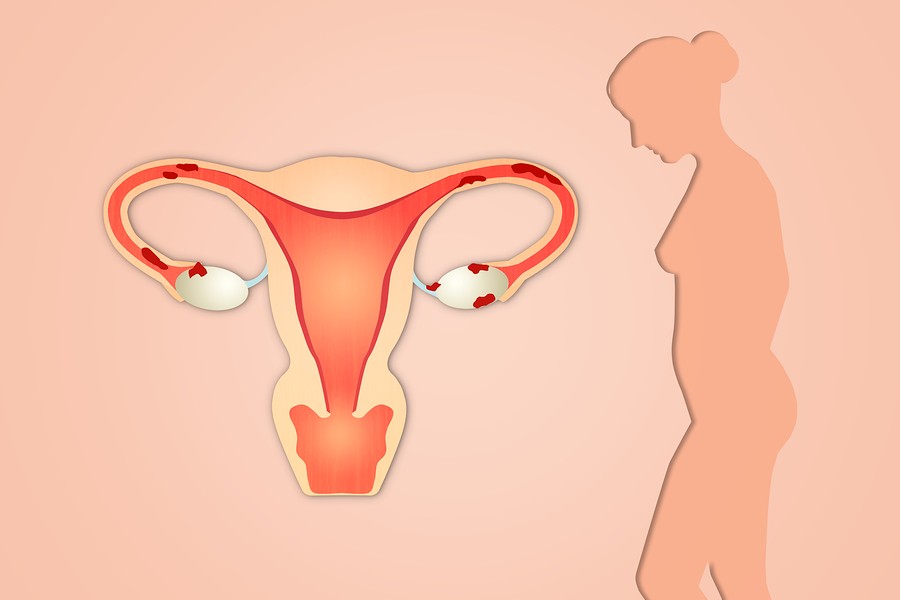 Endometriosis-Utero-Dolor-Uterino