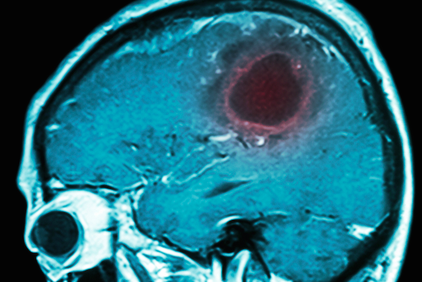 Tumores-Cerebrales-Cerebro-Estudios-Imagen